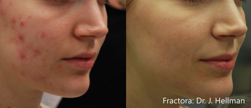 Fractora V Antes y después de
