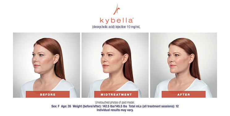 Kybella Before & After