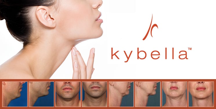 Kybella Antes y después de