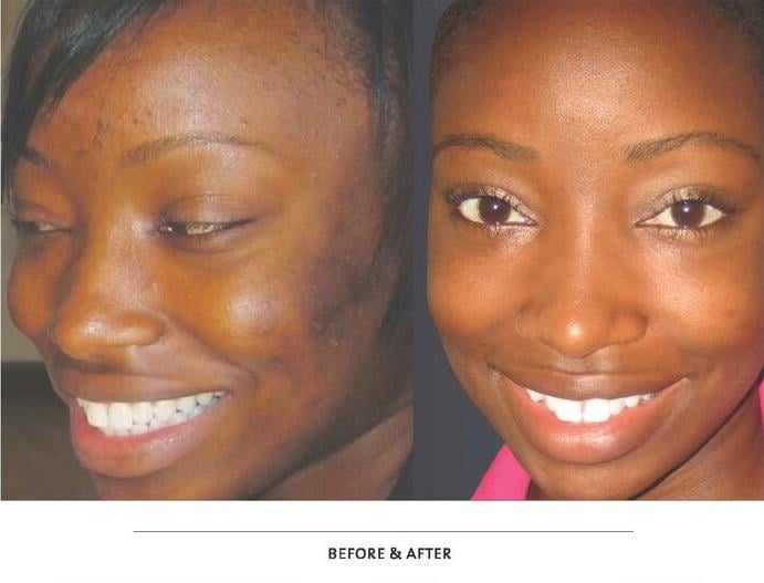 VI Peel - PURIFY with PRECISION PLUS Before & After