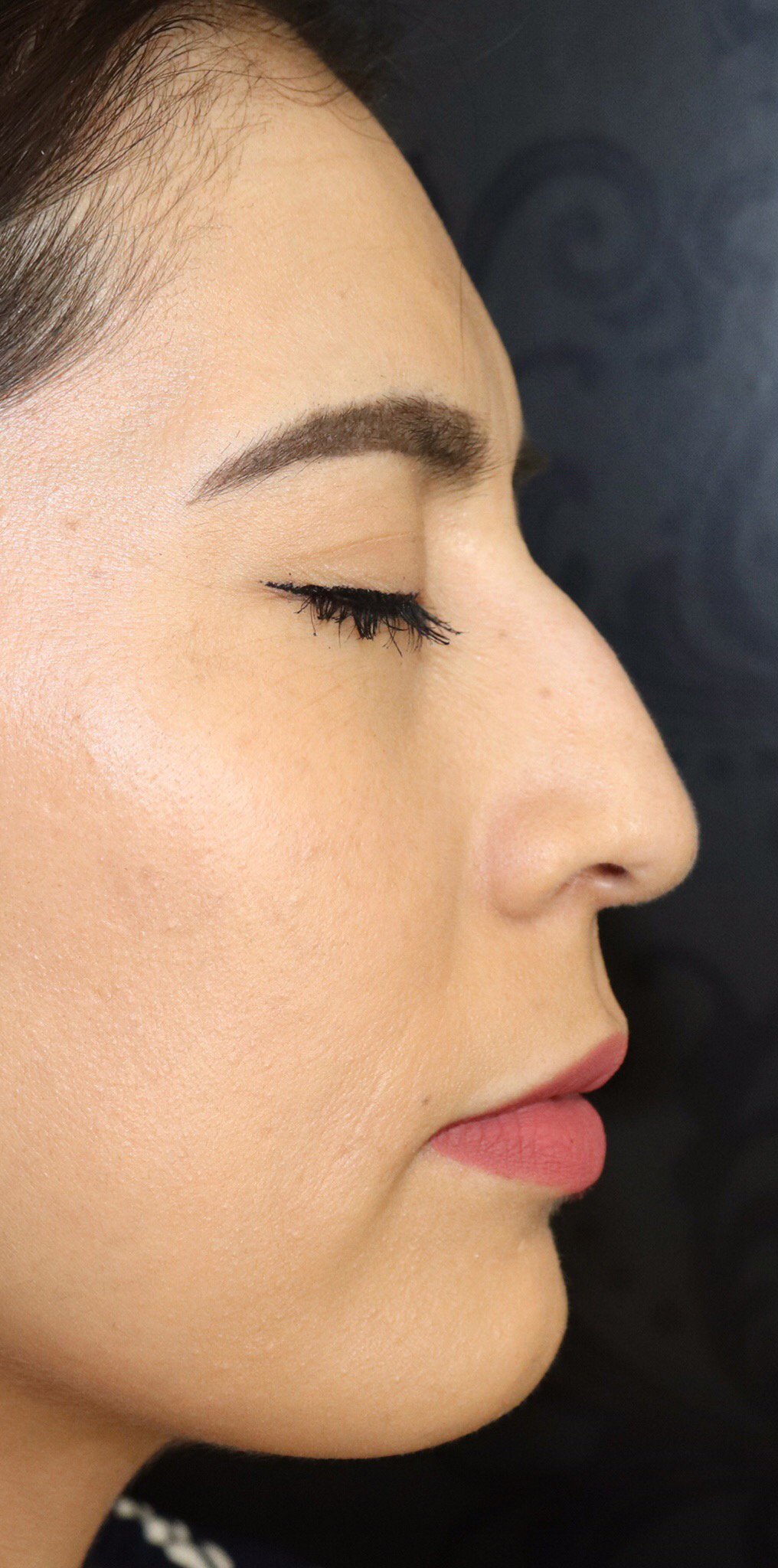 Non-Surgical Rhinoplasty