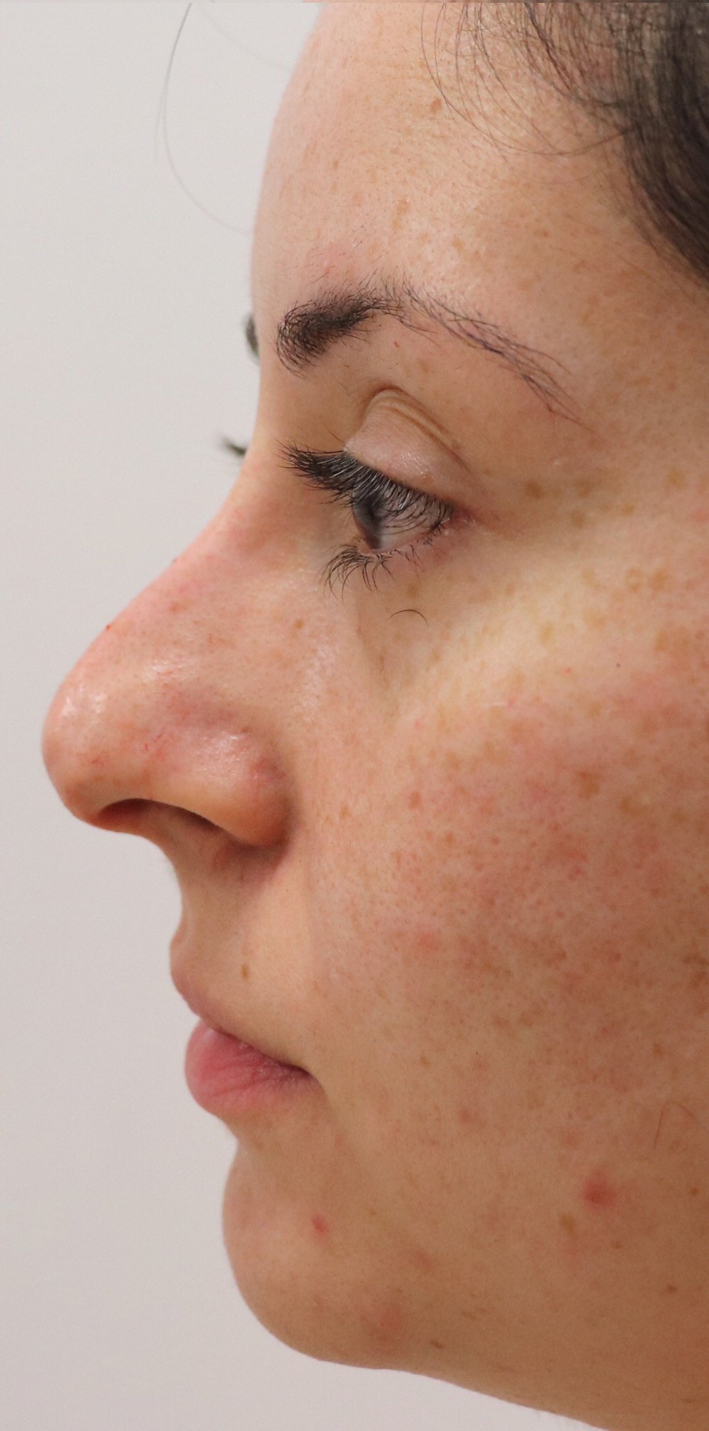 Non-Surgical Rhinoplasty