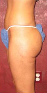 Liposuction