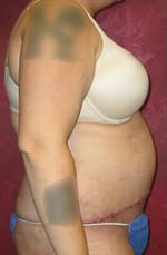 Tummy Tuck