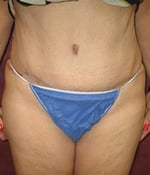 Tummy Tuck