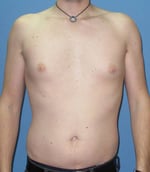 Liposuction
