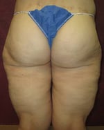 Thigh Lift
