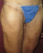 Thigh Lift