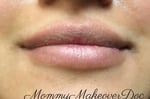 Lip Augmentation