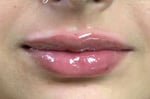 Lip Augmentation