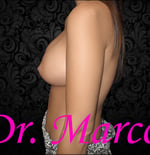 Breast Augmentation