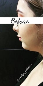 Non-surgical Chin Augmentation