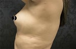 Breast Augmentation