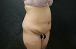 Tummy Tuck