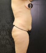 Tummy Tuck