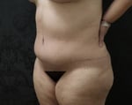 Tummy Tuck