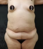 Mommy Makeover