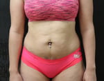 Liposuction