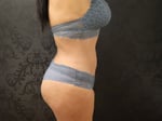 Liposuction