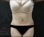 Liposuction