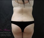 Liposuction