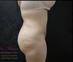 Liposuction