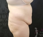Liposuction