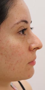 Non-Surgical Rhinoplasty