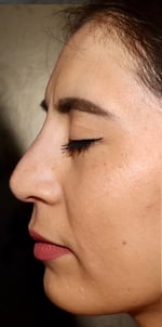 Non-Surgical Rhinoplasty