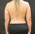 Breast Lift