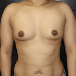 Breast Augmentation