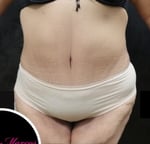 Liposuction