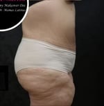 Liposuction