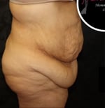 Liposuction