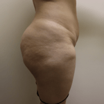 Liposuction