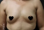 Breast Augmentation