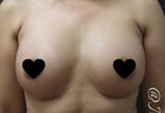 Breast Augmentation