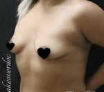 Breast Augmentation