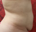 Tummy Tuck