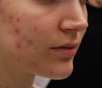 Fractora V