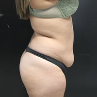 Mini Tummy Tuck