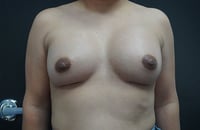 Breast Augmentation