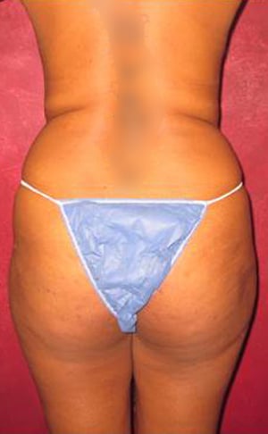 Liposuction