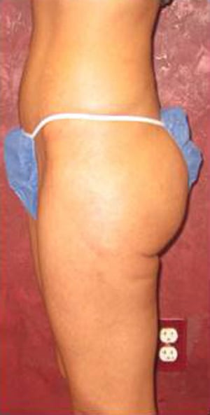 Liposuction