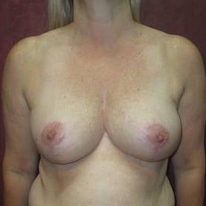 Breast Lift