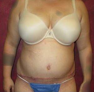 Tummy Tuck