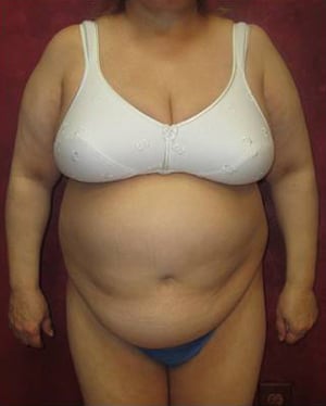 Tummy Tuck