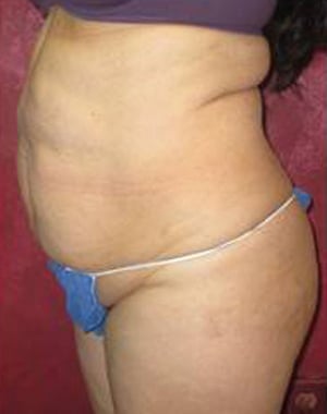 Tummy Tuck