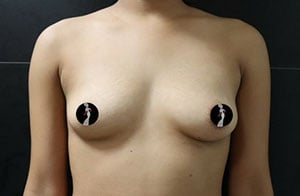 Breast Augmentation