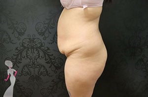 Tummy Tuck